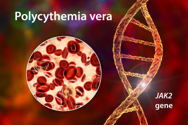 Moderní terapie polycythemia vera: Od farmakologie a genetiky až po řešení složitých klinických případů