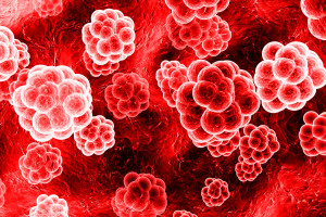 Aktuální možnosti biologické léčby u nemocných s myelodysplastickým syndromem