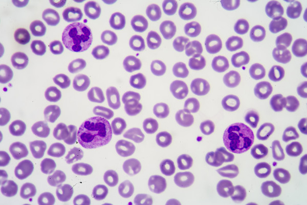 Perzistentní polyklonální B-lymfocytóza může imitovat hematologickou malignitu